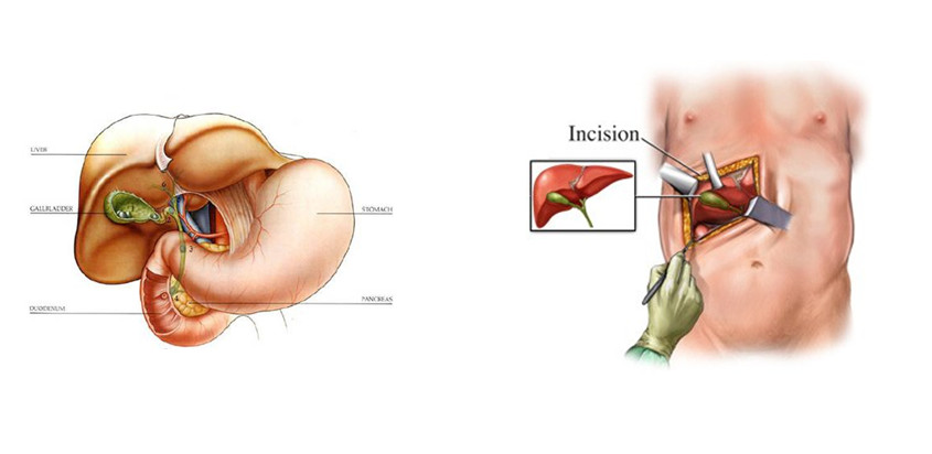 CBD Bile Duct Exploration